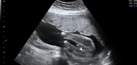 تفاصيل الاسبوع الثالث عشر من الحمل وجنس الجنين – الشعاع